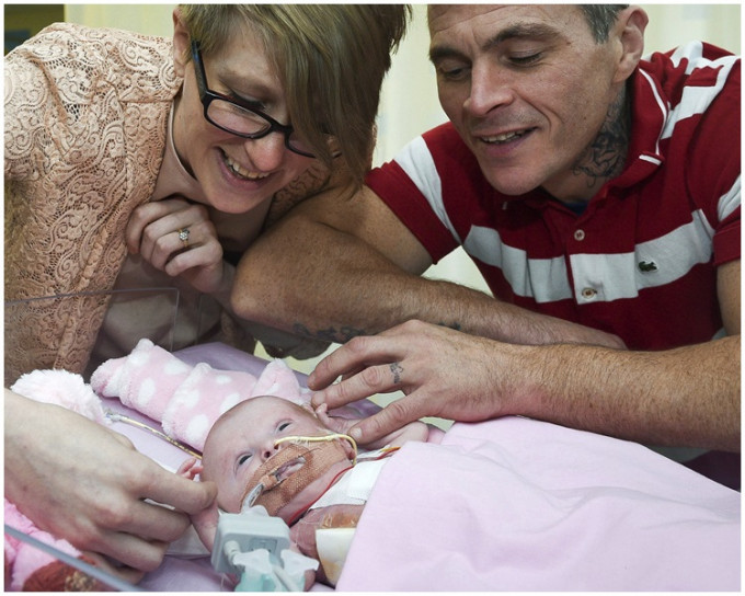 雲妮露成為了英國第一個心臟異位卻成功存活的嬰兒。AP