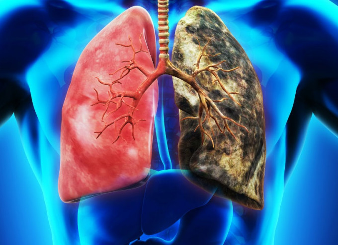 抗生素有機會用於治療肺癌。網上圖片