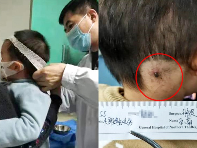 遼寧2歲男童遭蜱蟲叮咬後腦。網圖