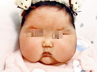 ■女婴变大脸娃娃，所用抑菌霜被证实含激素。