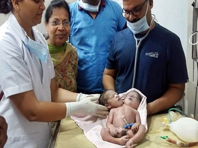 印度年輕孕婦誕下畸型男嬰。網圖