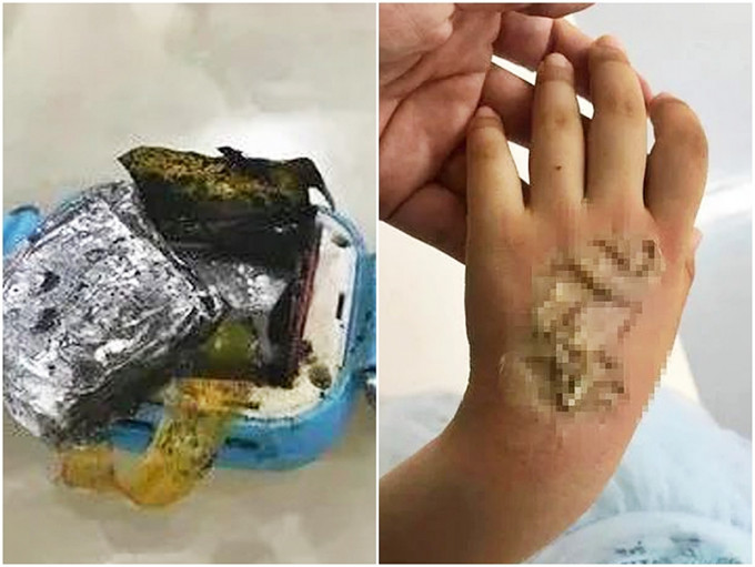 福建一名女童所佩戴的儿童智能手表突然自燃，导致其手背三级烧伤。网图