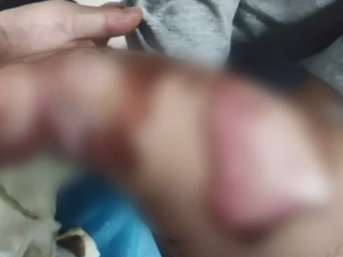 幼童被電熱氈灼傷。微博圖片
