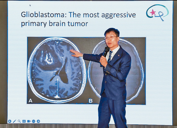 张嘉文医生指，胶质母细胞瘤是很难医治的原发性脑瘤，患者即使开刀也难完全清除。