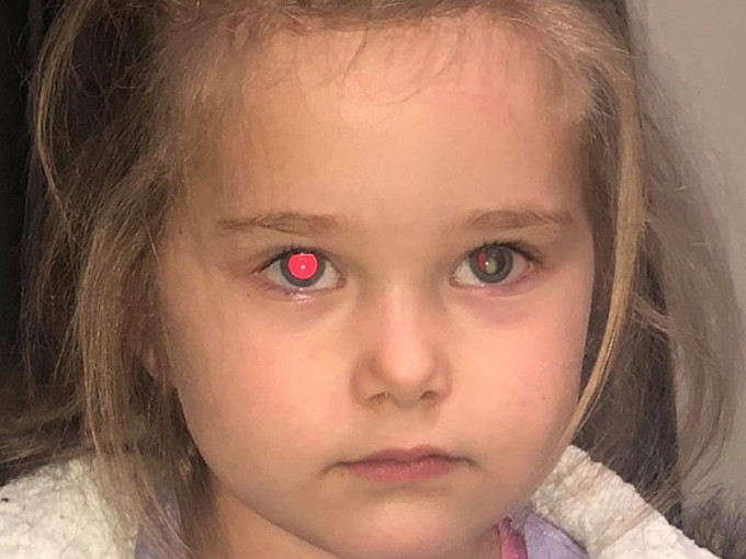 澳洲一位母亲开闪光灯替4岁女儿拍照，发现其右眼出现「红眼」，但左眼却没有这种状况。　网上图片