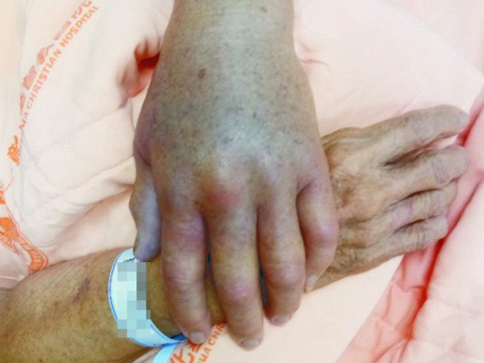 被魚鰭刺傷染創傷弧菌，台灣老婦手掌腫脹發黑。網圖