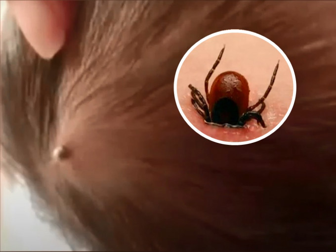 内地一名出生仅4天的婴儿遭蜱虫咬伤，4天后蜱虫头部已完全钻入婴孩头部。短片截图