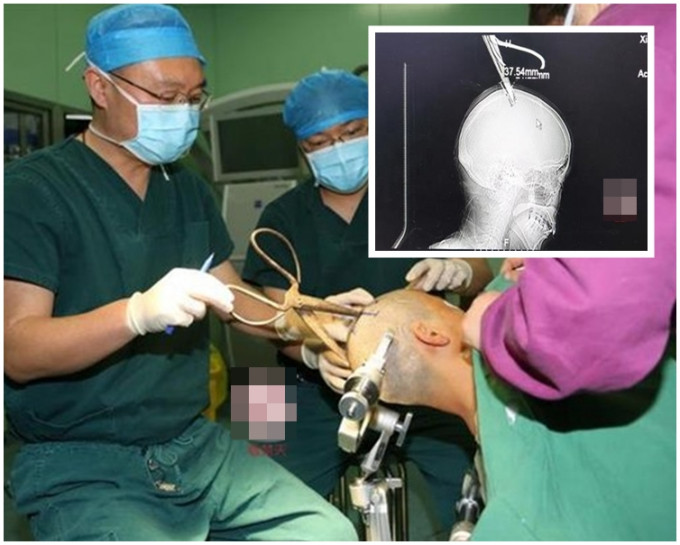 剪刀刀尖斜嵌在農婦的顱骨裡，離腦髓只有2、3厘米。網圖