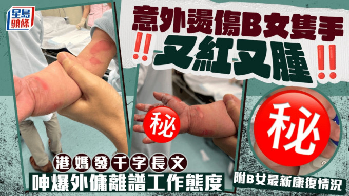 意外烫伤B女只手又红又肿 港妈发千字长文 呻爆外佣离谱工作态度