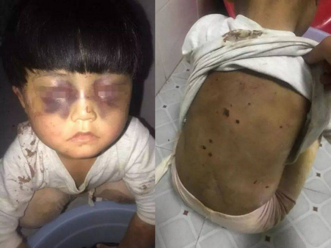 贵州4岁童疑遭家人虐待，全身瘀青双眼红肿。（网图）