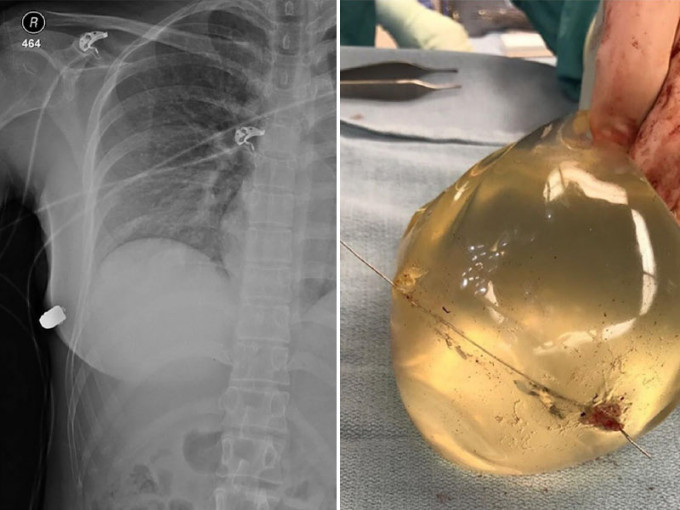 隆胸矽胶让子弹偏离心脏，成功挽救她的性命。(网图)