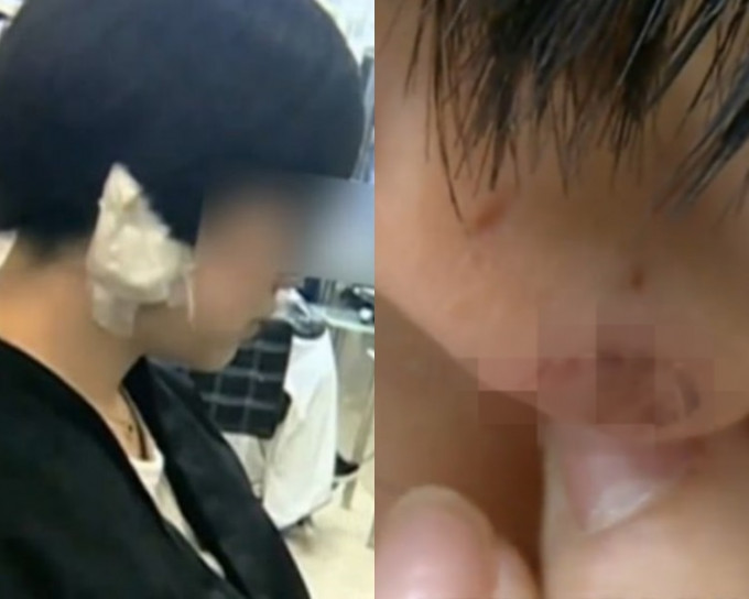 深圳一名女子剪发时遭剪耳珠。网上图片