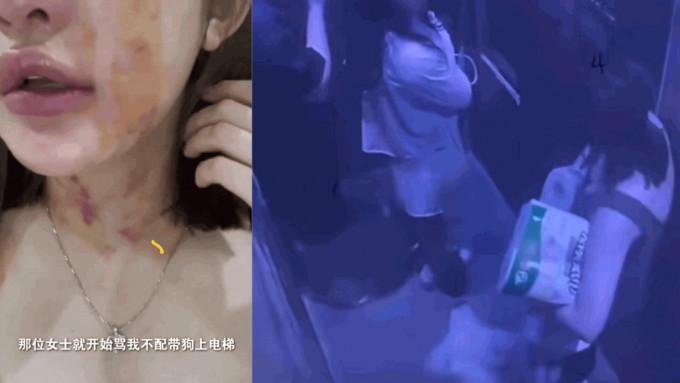 女子带狗搭𨋢与邻居争执，被打至满脸满项瘀痕。