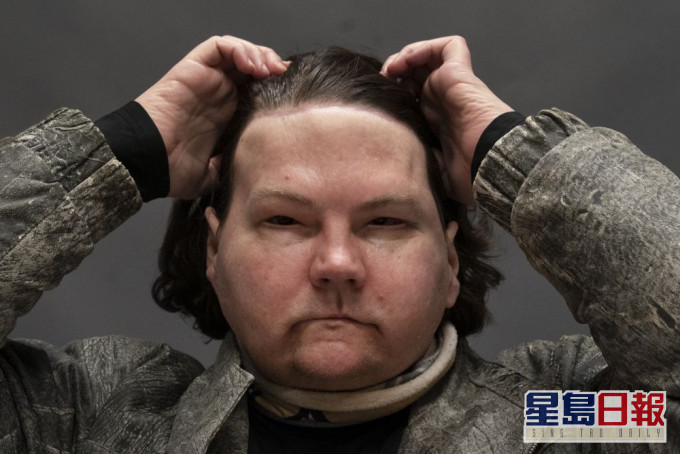 美國男子因意外全身80%三級燙傷,臉部及雙手移植成功,為全球首例。AP圖片