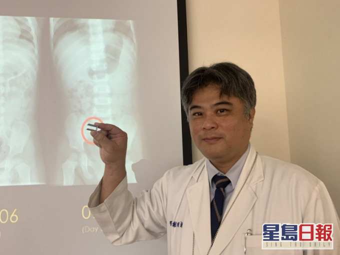 謝明諭指,嬰幼兒誤食異物,觀察期最多是4個星期。網圖