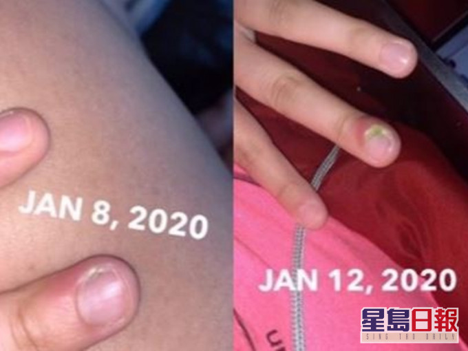 少女愛咬指甲險些面臨截肢。網上圖片