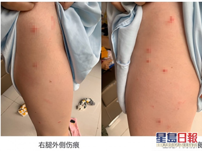 事主展示傷勢。網圖