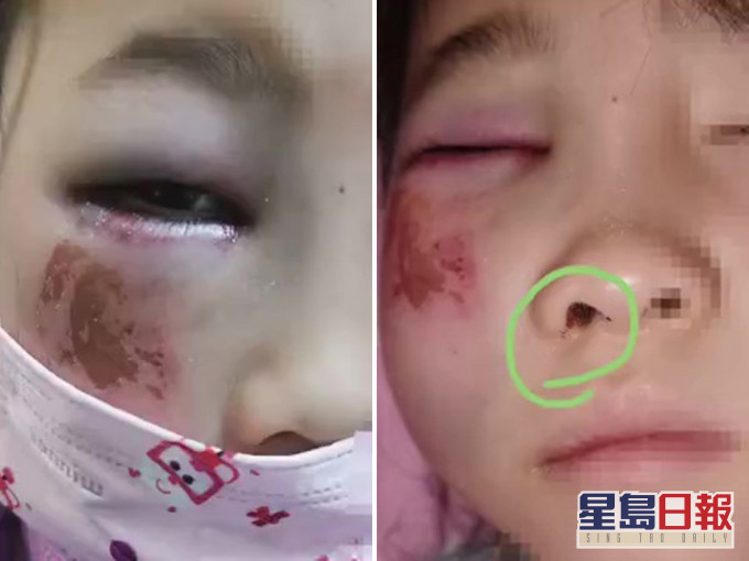 小學生算錯題遭老師毆打險失明。(網圖)