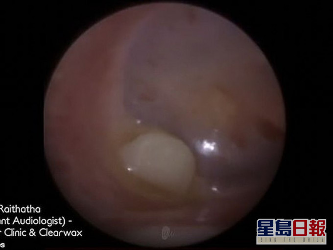 英國3歲男童感耳痛求診,醫生驚見耳內藏「乳齒」。