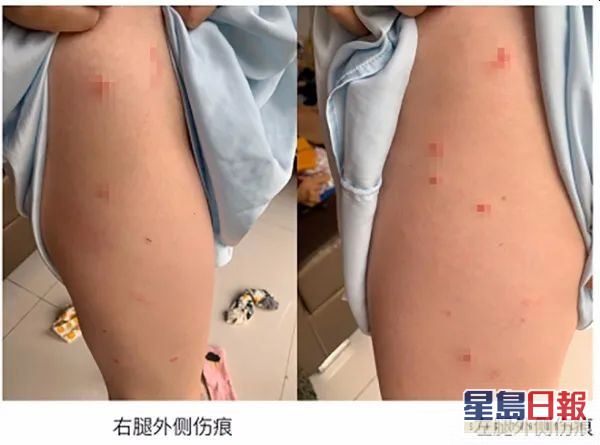 受害女事主腿部受傷照片。(圖片來源於舉報信截圖)
