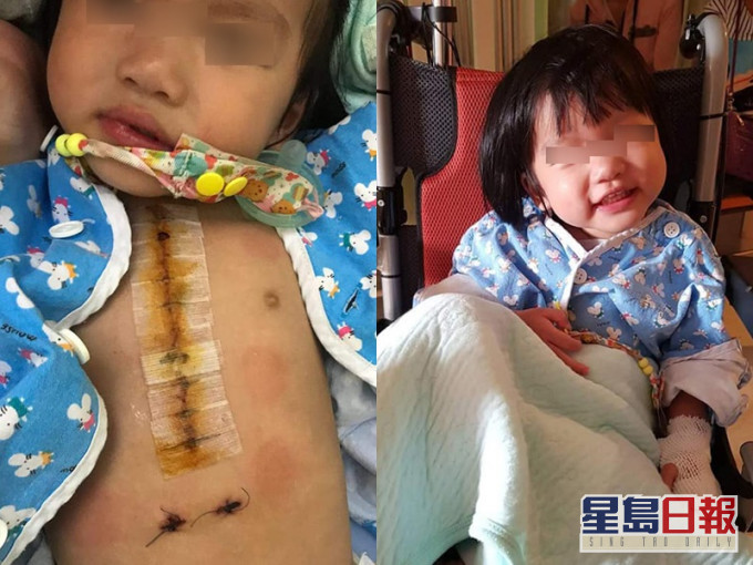 2歲女兒已經做過2次大手術。網圖
