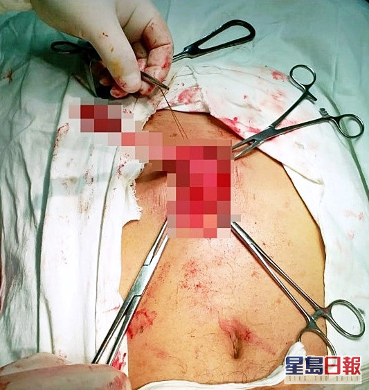 印度一名39歲男子刷牙時不慎吞下整枝牙刷。網圖
