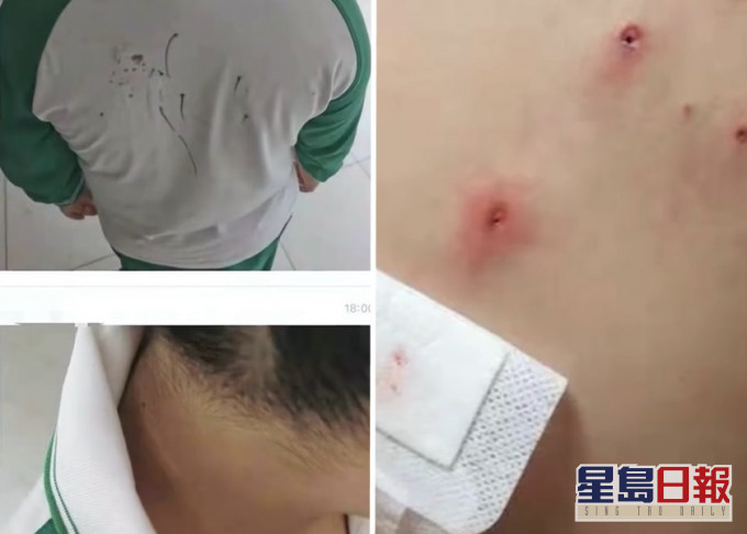 廣州一名小一生疑被同學欺凌,用鉛筆刺傷身體多處。影片截圖