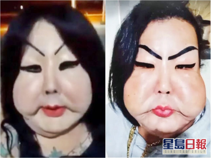 奧利韋拉整容失敗,導致臉頰腫脹。網圖