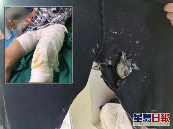 男子雙腿和手多處被燒傷。網圖