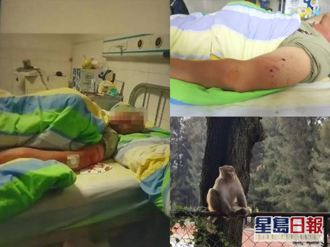 被群猴圍攻的男子左臂和左腿多處被猴子抓傷、咬傷,腰椎一二節因摔倒致壓縮性骨折。(網圖)