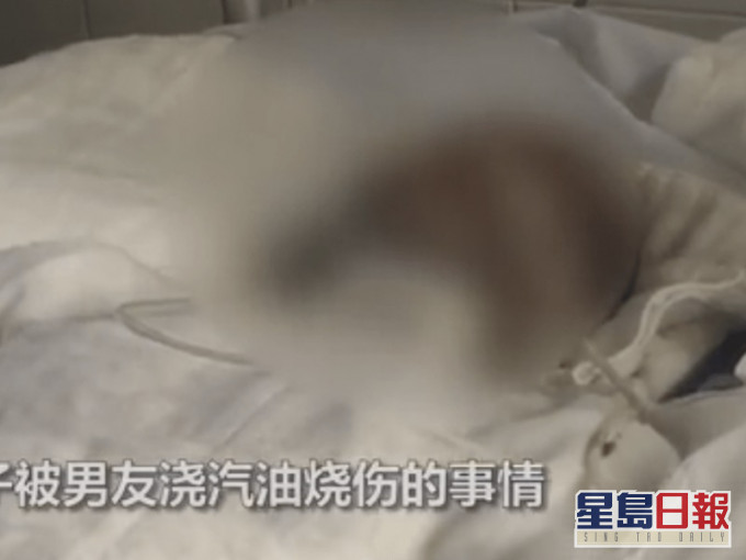 張女全身42%面積三度燒傷留醫。網圖