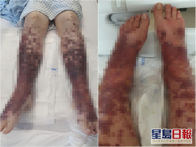 34歲女子接種阿斯利康疫苗後出現嚴重過敏。網圖