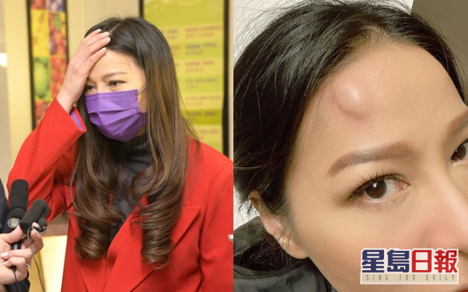 阿滕谓幸好没爆头,半日已消肿。