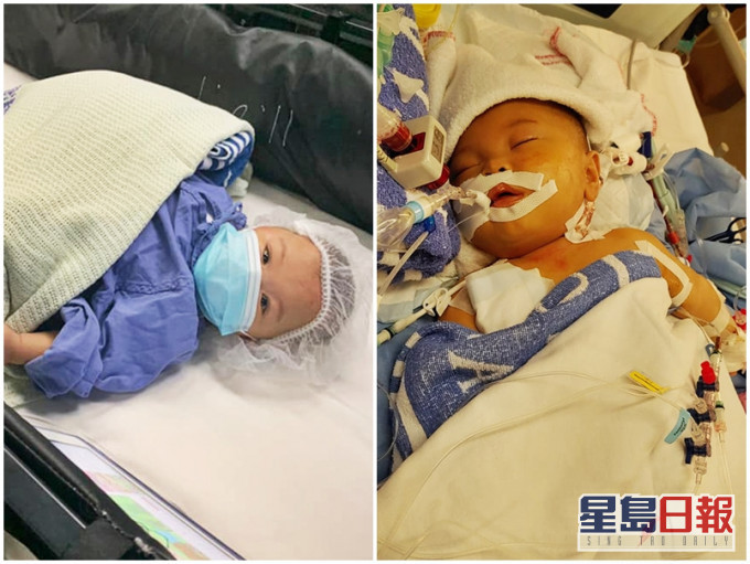 早產嬰悅悅一出生便患有壞死性腸炎,至今已接受多次手術。「CoKa.Kona Baby」FB圖片