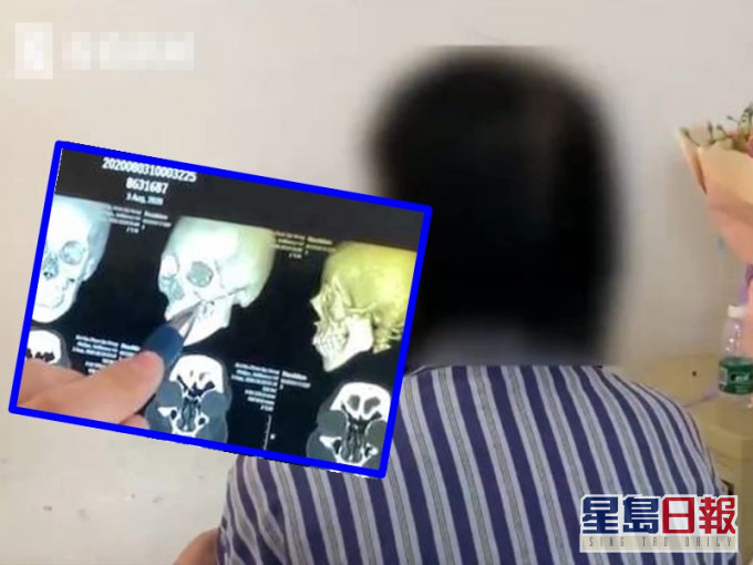 遼寧瀋陽一名23歲的姓劉女子,在水上樂園不慎與人發生碰撞,導致左臉顴骨4處骨折,險些毀容。網圖
