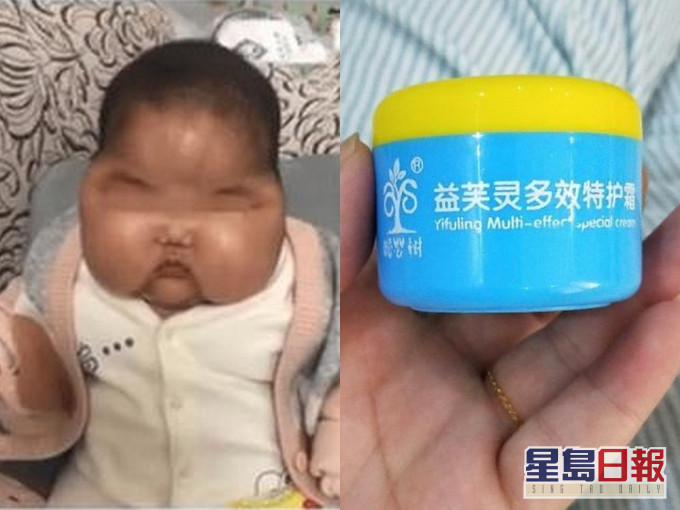 5個月大的嬰兒使用面霜後變大頭娃娃,檢測發現面霜含糖皮質激素。