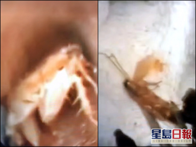 鼻喉科醫生從耳窩取出曱甴的過程。來講兒科急診的543-吳昌騰醫師FB影片截圖