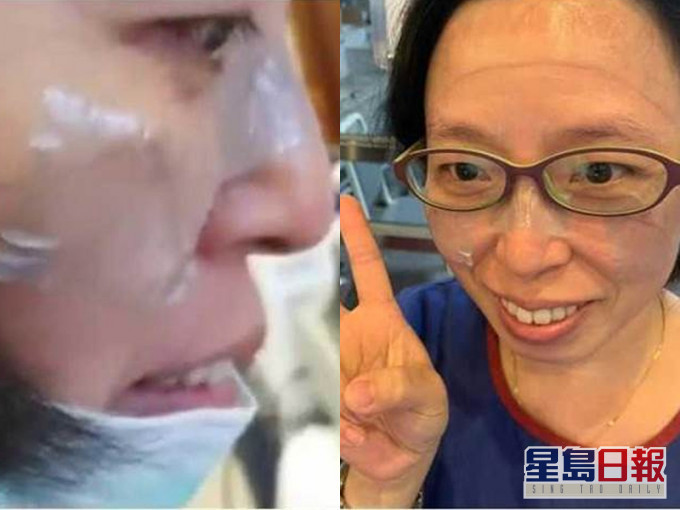 花莲慈济医院粉专,贴出了多张医护口罩戴到脸破皮照片,甚至有医护需贴上人工皮。(网图)