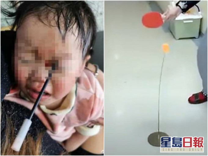 內地3歲女童玩彈力乒乓球,不慎讓不鏽鋼軟軸直插左眼,未來恐損視力。網上圖片