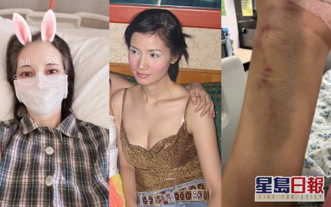 鄭艷麗自拍臥病床及抽血等隻手瘀黑照。