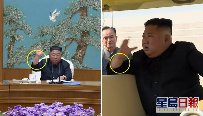 影片中發現金正恩右手腕上疑有注射痕跡。Twitter