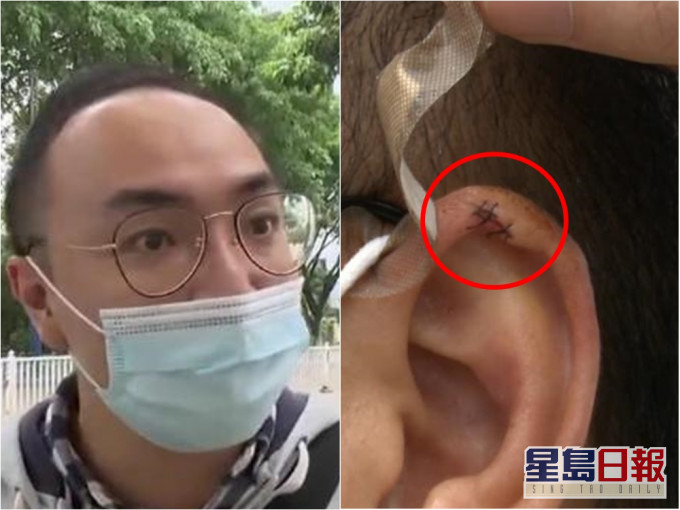 佛山男子被髮型師割傷。網圖