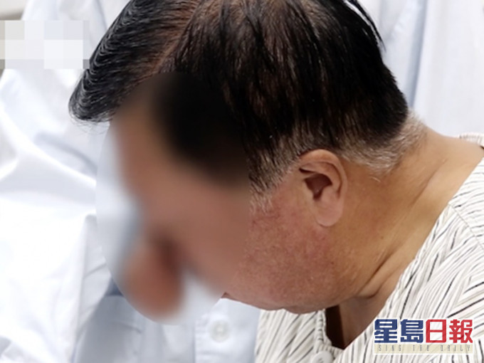 李男這個息肉「象鼻」大如鵝蛋。網圖