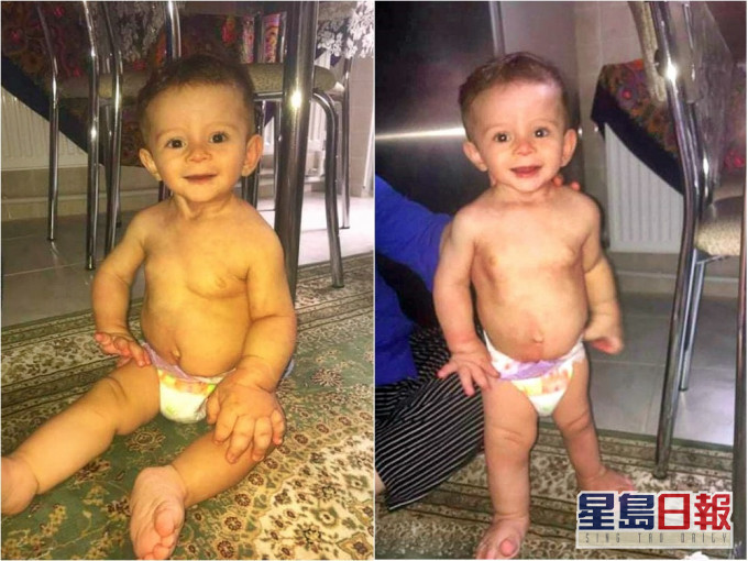 土耳其男童患罕見病,半邊手腳比平常人大。網圖