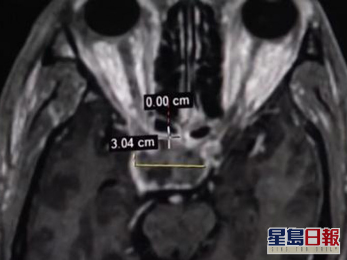 医师发现病人颅内长了肿瘤。(网图)