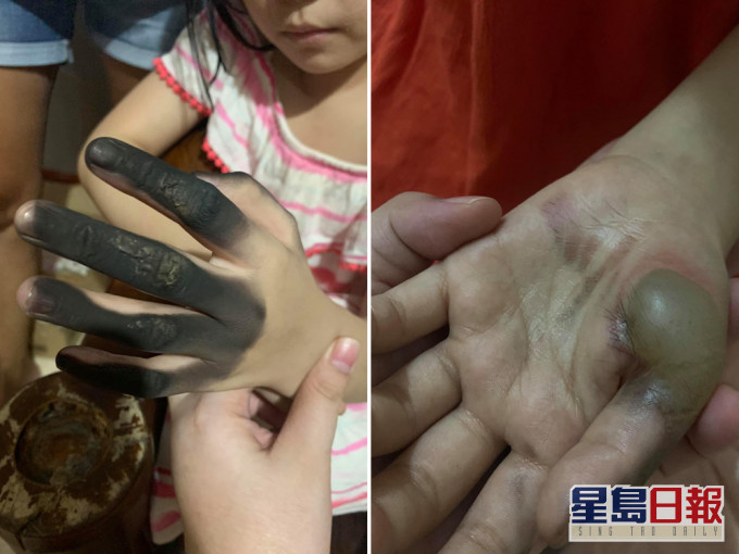 女童4指被烧黑，手掌起大水泡。（网图）
