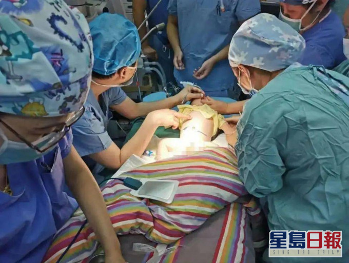 剛滿月男嬰剖腹誕下「寄生胎」。(網圖)