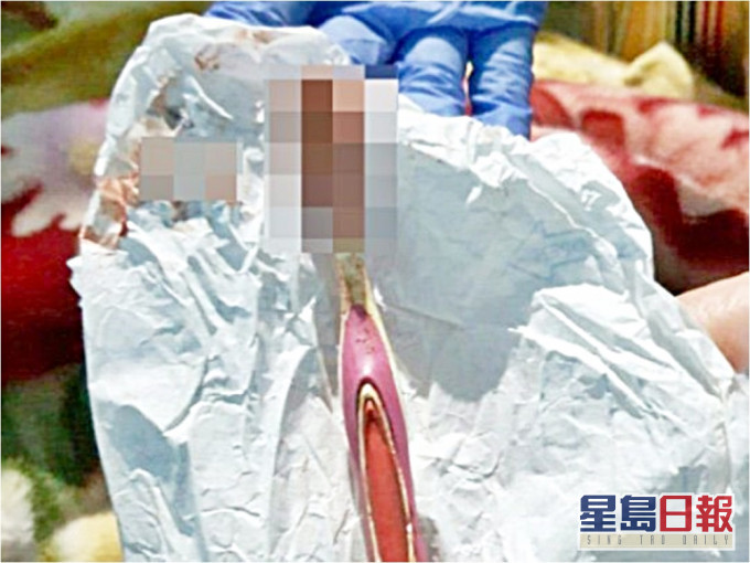 醫生開刀把牙刷取出。網圖