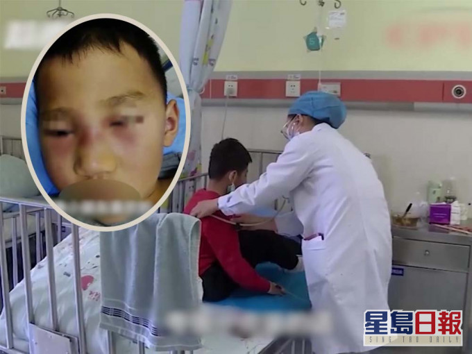 滔滔面部出現蜂窩組織炎,醫生稱他腫得像鹹蛋超人。互聯網圖片