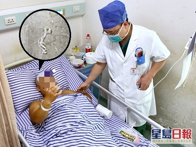 醫生從男子腦內取出一條12厘米長寄生蟲。網圖